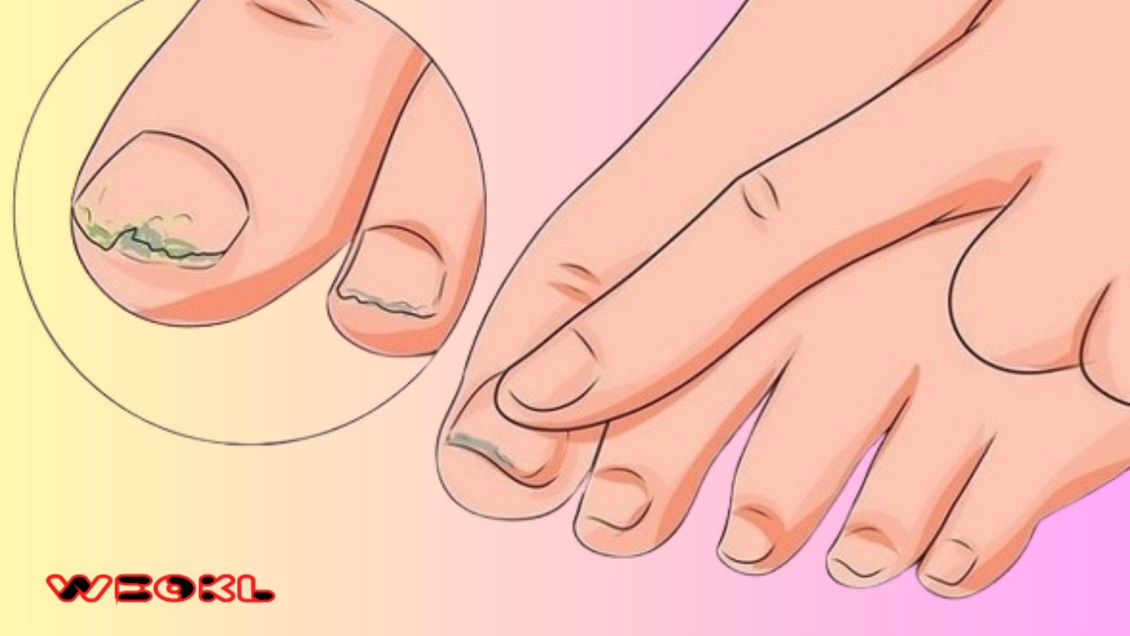 How to get rid of painful toenails without a doctor