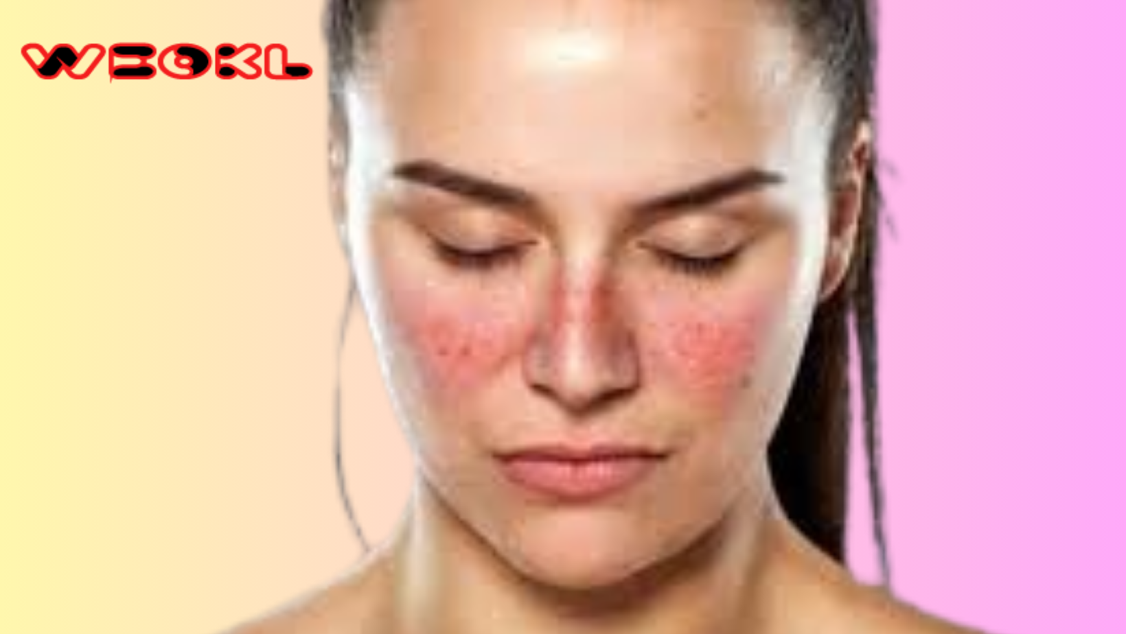 10 Early Signs of Lupus