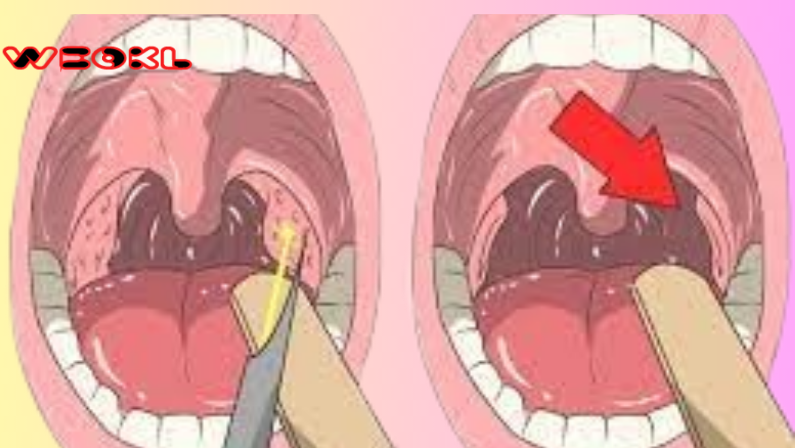 Remove Tonsil Stones Without Any Surgery!