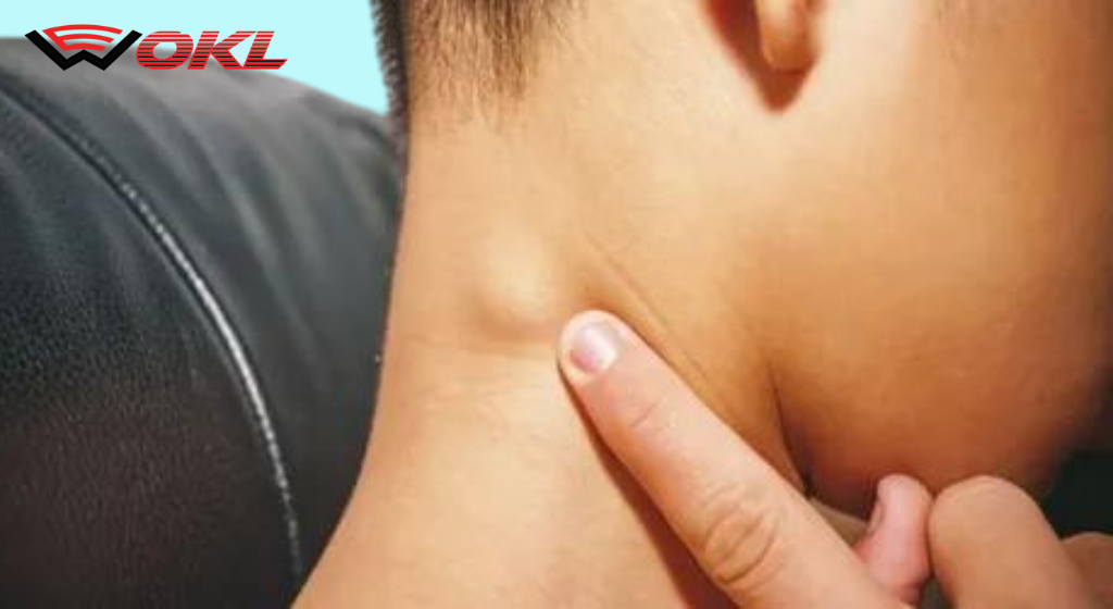 DO YOU HAVE A LUMP ON YOUR NECK, BACK OR BEHIND YOUR EAR? HERE�S WHAT YOU NEED TO KNOW